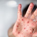 dlja-etoj-infektsii-harakterna-pochti-100-vospriimchivost rect 360311b8fcf13391f642d4a32d8472d3